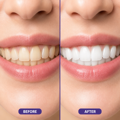 Purple Teeth Whitening Kit